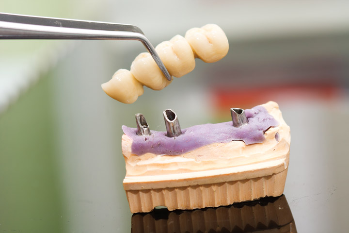 dental bridge