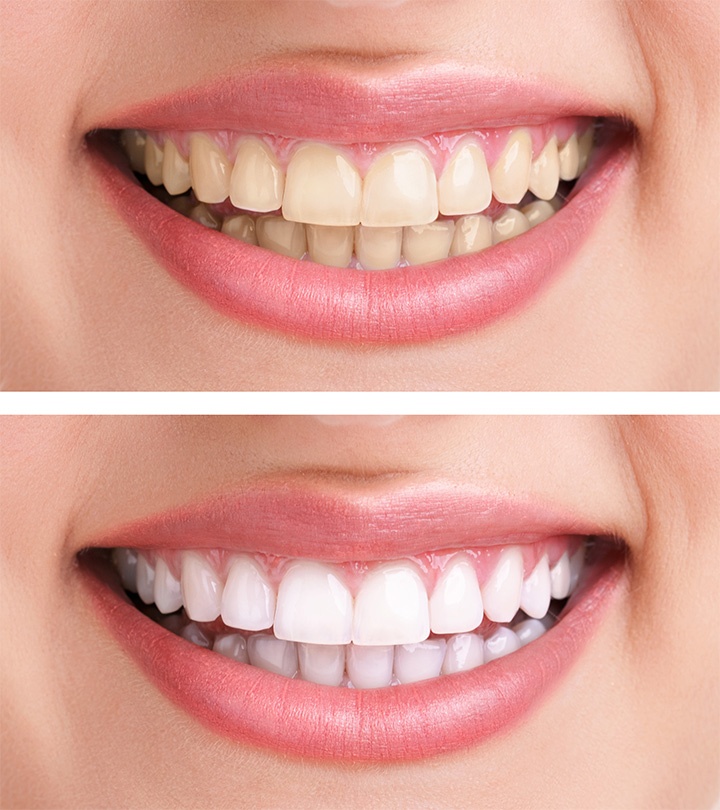 whitening_2